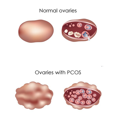 Normal ovaries vs ovaries with PCOS